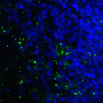 Immunofluorescence of B7-H3 in human colon carcinoma tissue cells using B7-H3 Antibody at 10 μg/ml.<br><br>Green: B7-H3 Antibody [10G6] (RF16095) <br> Blue: DAPI staining