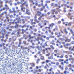 Immunohistochemistry of B7-H3 in human colon carcinoma tissue using B7-H3 Antibody and control mouse IgG (corner box) at 2 μg/ml.