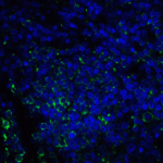 Immunofluorescence of B7-H3 in human colon carcinoma tissue cells using B7-H3 Antibody at 10 μg/ml.<br><br>Green: B7-H3 Antibody [2A7] (RF16092) <br> Blue: DAPI staining