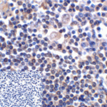 Immunohistochemistry of B7-H3 in human colon carcinoma tissue using B7-H3 Antibody and control mouse IgG (corner box) at 2 μg/ml.