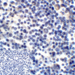 Immunohistochemistry of B7-H3 in human colon carcinoma tissue using B7-H3 Antibody and control mouse IgG (corner box) at 2 μg/ml.