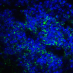 Immunofluorescence of B7-H3 in human colon carcinoma tissue cells using B7-H3 Antibody at 10 μg/ml.<br><br>Green: B7-H3 Antibody [4H3] (RF16093) <br> Blue: DAPI staining