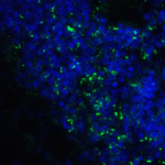 Immunofluorescence of B7-H3 in human colon carcinoma tissue cells using B7-H3 Antibody at 10 μg/ml.<br><br>Green: B7-H3 Antibody [7B3] (RF16094) <br> Blue: DAPI staining