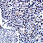Immunohistochemistry of B7-H3 in human colon carcinoma tissue using B7-H3 Antibody and control mouse IgG (corner box) at 2 μg/ml.