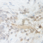 This antibody stained formalin-fixed, paraffin-embedded sections of human breast malignant carcinoma.  The recommended concentration is 5.0 ug/ml with an overnight incubation at 4C.  An HRP-labeled polymer detection system was used with a DAB chromogen.  Heat induced antigen retrieval with a pH 9.0 buffer is recommended.  See photo(s).  Optimal concentrations and conditions may vary.