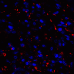 Immunofluorescence of CD80 in human stomach carcinoma tissue with CD80 antibody at 20 μg/mL. <br><br>Red: CD80 Antibody [10A1] (RF16042) <br> Blue: DAPI staining