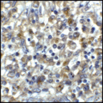 Immunohistochemistry of CD80 in human stomach carcinoma tissue with CD80 antibody at 5 μg/mL.