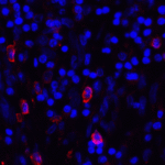 Immunofluorescence of CD80 in human stomach carcinoma tissue with CD80 antibody at 20 μg/mL. <br><br>Red: CD80 Antibody [11C12] (RF16045) <br> Blue: DAPI staining