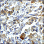 Immunohistochemistry of CD80 in human stomach carcinoma tissue with CD80 antibody at 5 μg/mL.