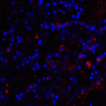 Immunofluorescence of CD80 in human stomach carcinoma tissue with CD80 antibody at 20 μg/mL. <br><br>Red: CD80 Antibody [11D1] (RF16044) <br> Blue: DAPI staining