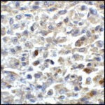 Immunohistochemistry of CD80 in human stomach carcinoma tissue with CD80 antibody at 5 μg/mL.