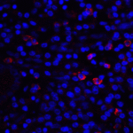 Immunofluorescence of CD80 in human stomach carcinoma tissue with CD80 antibody at 20 μg/mL. <br><br>Red: CD80 Antibody [12D9] (RF16046) <br> Blue: DAPI staining