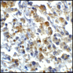 Immunohistochemistry of CD80 in human stomach carcinoma tissue with CD80 antibody at 5 μg/mL.