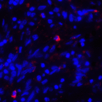 Immunofluorescence of CD80 in human stomach carcinoma tissue with CD80 antibody at 20 μg/mL. <br><br>Red: CD80 Antibody [7A2] (RF16043) <br> Blue: DAPI staining