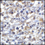 Immunohistochemistry of CD80 in human stomach carcinoma tissue with CD80 antibody at 5 μg/mL.