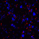 Immunofluorescence of CD80 in human stomach carcinoma tissue with CD80 antibody at 20 μg/mL. <br><br>Red: CD80 Antibody [8G12] (RF16041) <br> Blue: DAPI staining