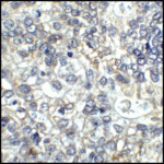 Immunohistochemistry of CD80 in human stomach carcinoma tissue with CD80 antibody at 5 μg/mL.
