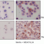 <strong>Figure 8 Immunocytochemistry Validation of DR4 in Human Melanoma Cells (Ekmekcioglu et al., 2008) </strong><br>MeWo melanoma cells were exposed to affinity-purified MDA7/IL-24. After 48 h of treatment, cells were collected and cytospins prepared for cytochemical assessment of their TRAIL receptor (R1 and R2) expression (anti-DR4 or anti-DR5, AEC, hematoxylin). Both DR4 and DR5 expression were upregulated in MeWo cells after treatment.