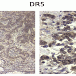<strong>Figure 14 Immunohistochemistry Validation of BIM in Human Colon Tumors (Devetzi et al., 2016) </strong><br>Protein analysis for DR5 by immunohistochemistry with anti-DR5 antibodies in human colon tumors. Strong immunoreactivity is shown for DR5 in T167 patient with colorectal cancer.