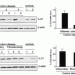 <strong>Figure  6 Induced Expression Validation of IL-21 expresssion in patients with Crohn's Disease (Monteleone et al, 2007) </strong><br>Enhanced IL-21 was observed in involved but not uninvolvedCD, and was not associated with any CD phenotype, such as fibrostenosing disease. IL-21 expression was detected by anti-IL-21 antibodies (2465).