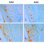 <strong>Figure 8 Immunohistochemistry Validation of IL-23 in Human Abdominal Aortic Aneurysm (AAA) Tissues (Yan et al., 2019)</strong><br>