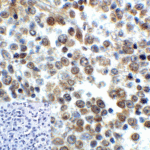 Immunohistochemistry of LAG-3 in human lymphoma tissue using LAG-3 Antibody and control mouse IgG (corner box) at 5 μg/ml.