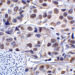 Immunohistochemistry of LAG-3 in human lymphoma tissue using LAG-3 Antibody and control mouse IgG (corner box) at 5 μg/ml.