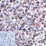 Immunohistochemistry of LAG-3 in human lymphoma tissue using LAG-3 Antibody and control mouse IgG (corner box) at 5 μg/ml.