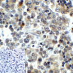 Immunohistochemistry of LAG-3 in human lymphoma tissue using LAG-3 Antibody and control mouse IgG (corner box) at 5 μg/ml.
