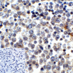 Immunohistochemistry of LAG-3 in human lymphoma tissue using LAG-3 Antibody and control mouse IgG (corner box) at 5 μg/ml.