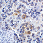 Immunohistochemistry of LAG-3 in human lymphoma tissue using LAG-3 Antibody and control mouse IgG (corner box) at 5 μg/ml.