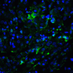 <strong>Figure 6 Immunofluorescence Validation of LSD1 in human breast carcinoma Tissue</strong><br>Immunofluorescent analysis of 4% paraformaldehyde-fixed human breast carcinoma Tissue labeling LSD1 with 3761 at 20 μg/mL, followed by goat anti-rabbit IgG secondary antibody at 1/500 dilution (green/blue).