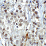 <strong>Figure 5 Immunohistochemistry Validation of LSD1 in Human Breast Carcinoma Tissue </strong><br> Immunohistochemical analysis of paraffin-embedded human breast carcinoma Tissue using anti-LSD1 antibody (3761) at 2 μg/ml. Tissue was fixed with formaldehyde and blocked with 10% serum for 1 h at RT; antigen retrieval was by heat mediation with a citrate buffer (pH6). Samples were incubated with primary antibody overnight at 4°C. A goat anti-rabbit IgG H&L (HRP) at 1/250 was used as secondary. Counter stained with Hematoxylin.