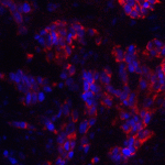 Immunofluorescence of MAGEA4 in human breast cancer tissue with MAGEA4 antibody at 20 μg/ml.<br><br>Green: MAGEA4 Antibody (8191) <br> Blue: DAPI staining