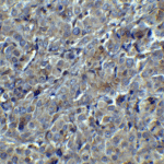 Immunohistochemistry of MAGEA4 in human breast tumor with MAGEA4 antibody at 5 μg/mL.