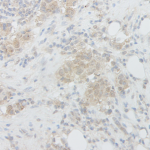 This antibody stained formalin-fixed, paraffin-embedded sections of human breast malignant carcinoma.  The recommended concentration is 5.0 ug/ml with an overnight incubation at 4C.  An HRP-labeled polymer detection system was used with a DAB chromogen.  Heat induced antigen retrieval with a pH 9.0 buffer is recommended.  Optimal concentrations and conditions may vary.