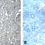 (A) Immunohistochemistry of PD-1 in human breast cancer tissue with PD-1 [10B3] antibody at 10 μg/mL. (B) Immunohistochemistry in human breast cancer tissue with control mouse IgG staining at 10 μg/mL.
