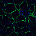 Immunofluorescence of PD-1 in human breast cancer tissue with PD-1 [4C7] antibody at 10 μg/mL. <br><br>Green: PD1 Antibody [4C7] (RF16004) <br> Blue: DAPI staining