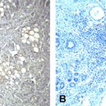 (A) Immunohistochemistry of PD-1 in human breast cancer tissue with PD-1 [4C7] antibody at 10 μg/mL. (B) Immunohistochemistry in human breast cancer tissue with control mouse IgG staining at 10 μg/mL.