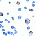 Immunocytochemistry of PD-1 in transfected 293 cells with PD-1 antibody at 5 μg/mL. Lower left: Immunocytochemistry in transfected 293 cells with control mouse IgG antibody at 5 μg/mL.