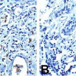 Immunohistochemistry of PD-1 in (A) human breast cancer tissue and (B) human normal breast tissue with PD-1 antibody at 5 μg/mL.