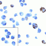 Immunocytochemistry of PD-1 in transfected 293 cells with PD-1 antibody at 5 μg/mL. Lower left: Immunocytochemistry in transfected 293 cells with control mouse IgG antibody at 5 μg/mL.