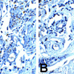 Immunohistochemistry of PD-1 in (A) human breast cancer tissue and (B) human normal breast tissue with PD-1 antibody at 5 μg/mL.