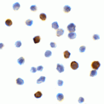 Immunocytochemistry of PD-L1 in transfected HEK293 cells with PD-L1 antibody at 1 μg/mL. Lower left: Immunocytochemistry in transfected HEK293 cells with control mouse IgG antibody at 1 μg/mL.