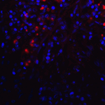 Immunofluorescence of PD-L1 in human stomach carcinoma tissue with PD-L1 antibody at 2 μg/mL. <br><br>Red: PDL1 Antibody [1D7] (RF16033) <br> Blue: DAPI staining
