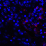 Immunofluorescence of PD-L1 in human stomach carcinoma tissue with PD-L1 antibody at 2 μg/mL. <br><br>Red: PDL1 Antibody [4F2] (RF16031) <br> Blue: DAPI staining