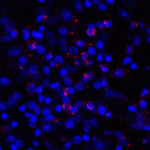 Immunofluorescence of PD-L1 in human stomach carcinoma tissue with PD-L1 antibody at 2 μg/mL. <br><br>Red: PDL1 Antibody [8E12] (RF16032) <br> Blue: DAPI staining