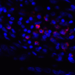 <strong>Figure 6 Immunofluorescence Validation of PD-L1 in Human Stomach Carcinoma Tissue</strong><br> Immunofluorescent analysis of 4% paraformaldehyde-fixed human stomach carcinoma tissue labeling PD-L1 with RF16035 at 2 μg/mL, followed by goat anti-mouse IgG secondary antibody at 1/500 dilution (red) and DAPI staining (blue).