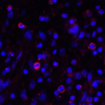 Immunofluorescence of PD-L1 in human stomach carcinoma tissue with PD-L1 antibody at 2 μg/mL. <br><br>Red: PDL1 Antibody [2D6] (RF16036) <br> Blue: DAPI staining