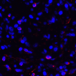 Immunofluorescence of PD-L1 in human stomach carcinoma tissue with PD-L1 antibody at 2 μg/mL. <br><br>Red: PDL1 Antibody [1F11] (RF16037) <br> Blue: DAPI staining